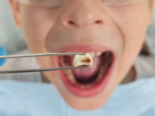 Best Emergency Dentist for Knocked-Out Tooth in Soap Lake, WA